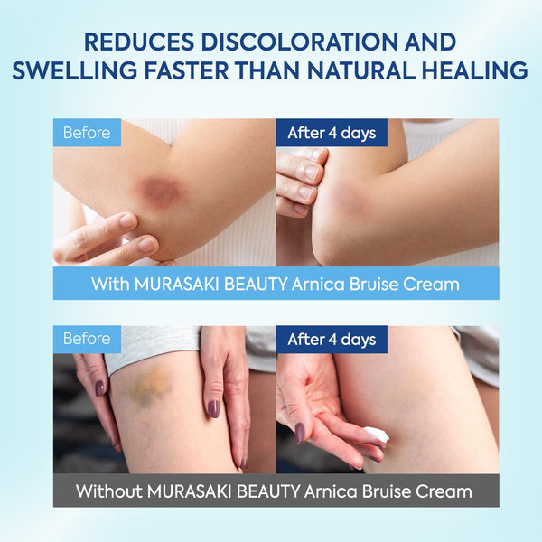 Arnica Bruise Cream Extra Strength: Fast Healing for Bruising and Swelling on Thin & Sensitive Skin - Enriched with Arnica Montana & Vitamins K, C & E - Daily Care for Teens, Adults & Seniors 4oz
