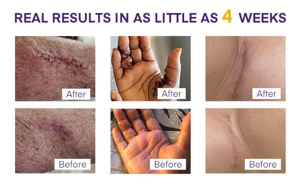 Silicone Scar Gel Day & Night Set - 100% Medical-Grade Silicone + SPF 30 Scar Cream for Surgical Scars, C-Section, Burns, Acne, Stretch Marks, Keloids – 1.06oz x 2 Tubes