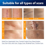 Silicone Scar Sheets for Surgical Scars: Silicone Gel Sheets for Keloids, Burns, Abrasion and C-Section - Safe for Adults and Children - Breathable, Skin-Friendly and Waterproof Silicone Tape 4PCS