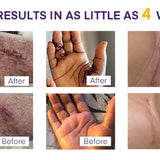 Silicone Scar Gel Scar Cream: SPF 30 Advanced Medical-Grade Formula for Surgical Scars, C-Section, Stretch Marks, Acne, Burns, Keloids, Old & New Scars – Broad Spectrum UV Protection 1.06oz (30g)